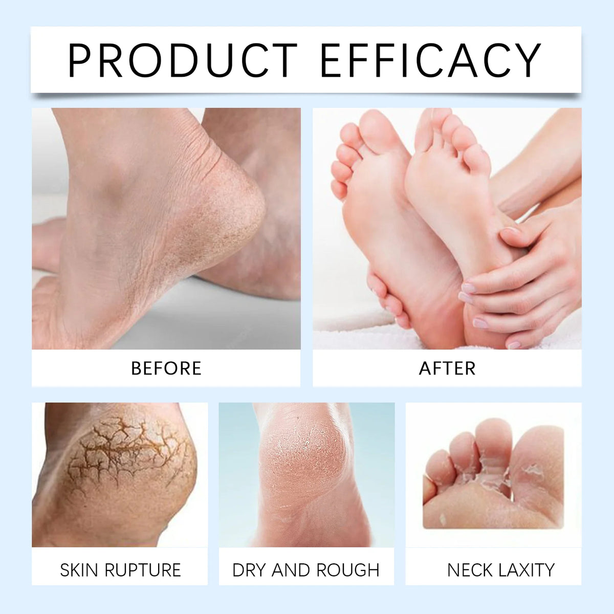 42% Urea Cream + 2% Salicylic Acid Foot Hand Cream for Dry Cracked Skin Exfoliating Callus Remover Moisturizer Pedicure At Home