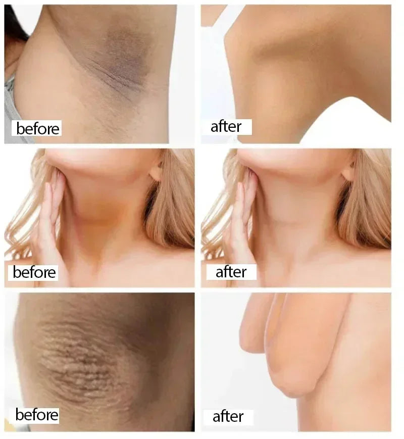 Whitening Cream Private Parts Underarm Bleaching Whiten Butt Knee Brighten Inner Thigh Intimate Parts Dark Remove Melanin