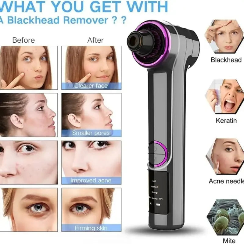 Blackhead Remover Pore Vacuum with Hot Compress, Upgraded Facial Pore Cleaner, Pore Extractor Acne White Heads Removal Tool