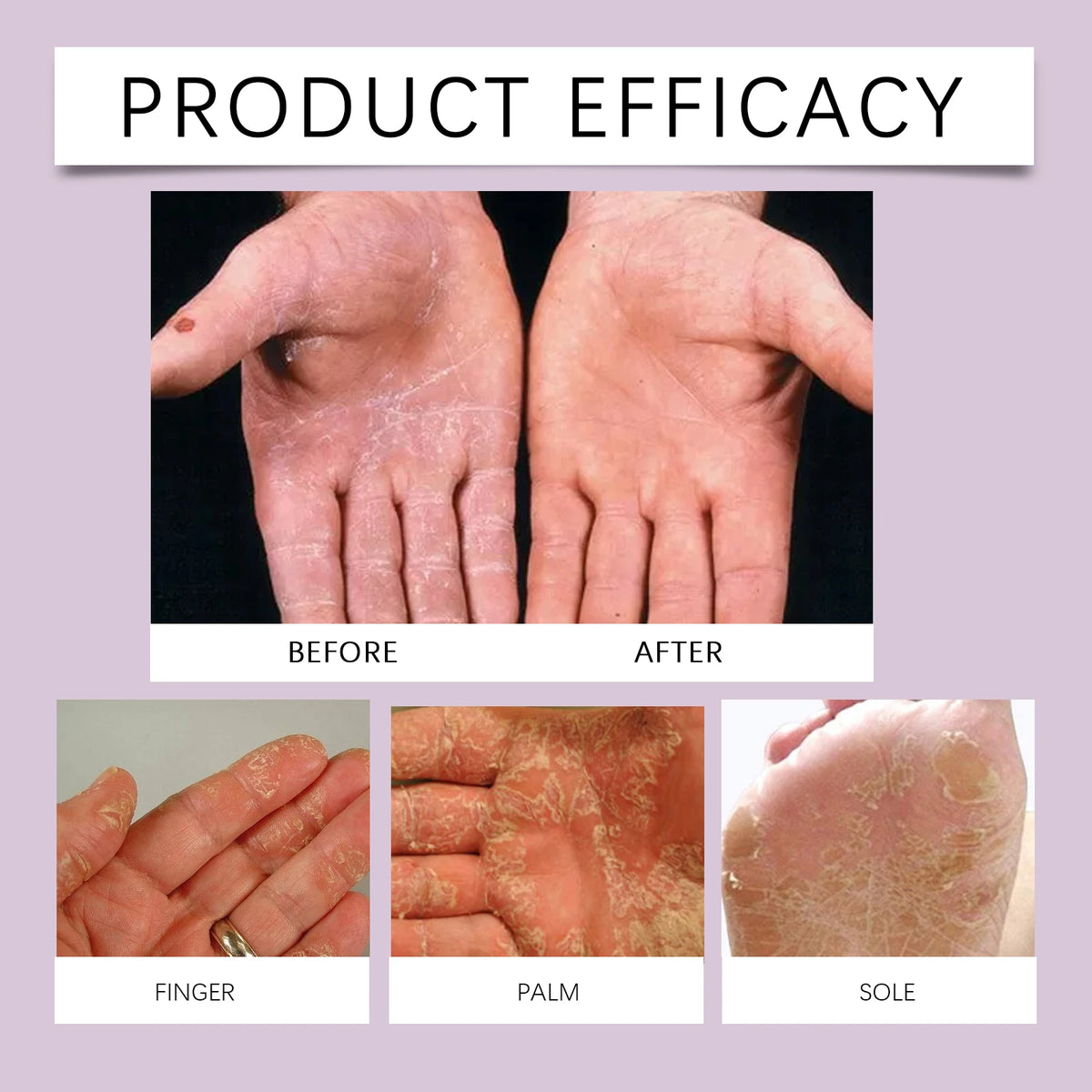 10% Urea Foot Cream Stick Moisturizing & Exfoliating, Cracked Heel Repair Deep Hydration for Dry Feet Long Protection Hand Cream